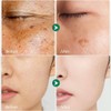 Quitamanchas para rostro y cuerpo, corrector de manchas oscuras con