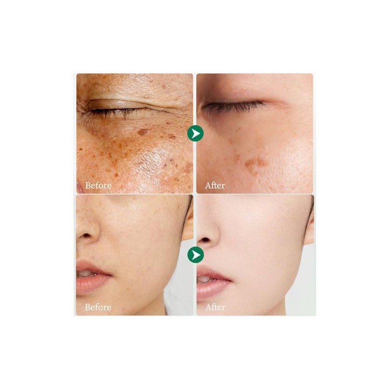 Quitamanchas para rostro y cuerpo, corrector de manchas oscuras con