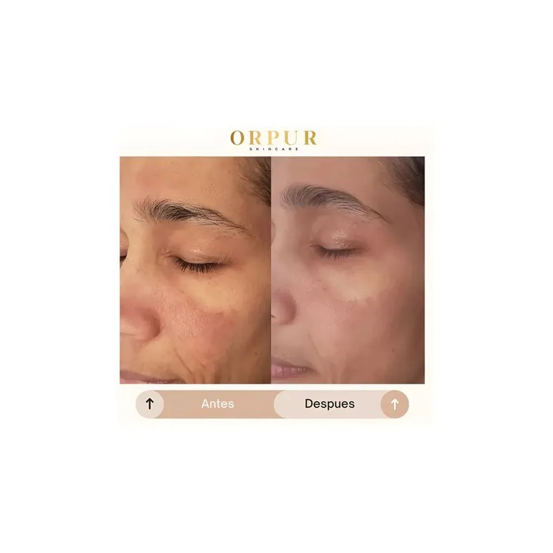 Crema Facial Hidratante Dermoaclaradora Anti Acne 4 Pack Todo Tipo