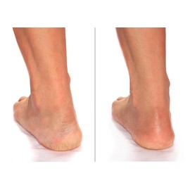 Advanced Clinicals Cracked Heel Foot Cream Skin Care Moisturizer Lotion For Feet W/Shea Butter | Helps Heal Cracked Skin, Rough Spots, Calluses, & Dry Skin | Foot Lotion | Hand Lotion| Large 8 Fl Oz