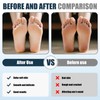 Callus Remover, Callus Remover Foot - Removes Calluses and Calluses