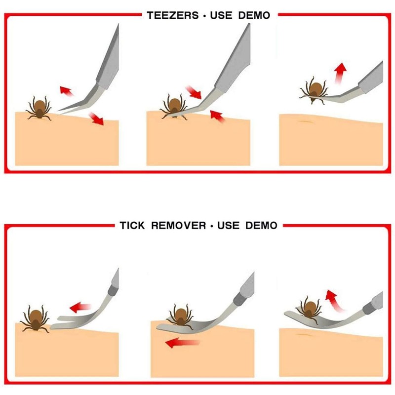 EasyULT 2 in 1 Tick Remover, Stainless Steel Professional Tick