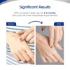 MURASAKI BEAUTY Silicone Scar Tape & Sheets – Removal on