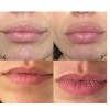 Beambo THE LIP GIZMO Pucker Up Plumping Lip Suction Device