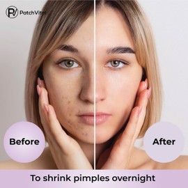 Patch Vital Pimple Patch - Hydrocolloid Acne Pimple Patch - Spot Stickers for Face - Cruelty Free Water Resistant Patches (24 Count)