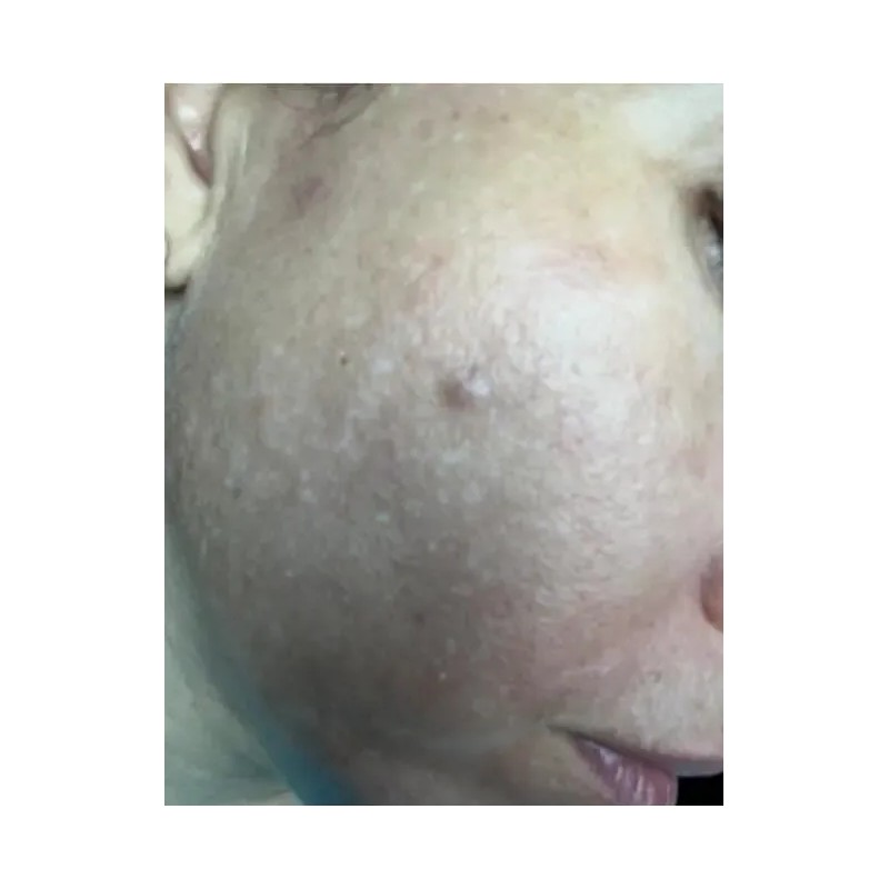 Crema Despigmentante De Paño Melasma Acne