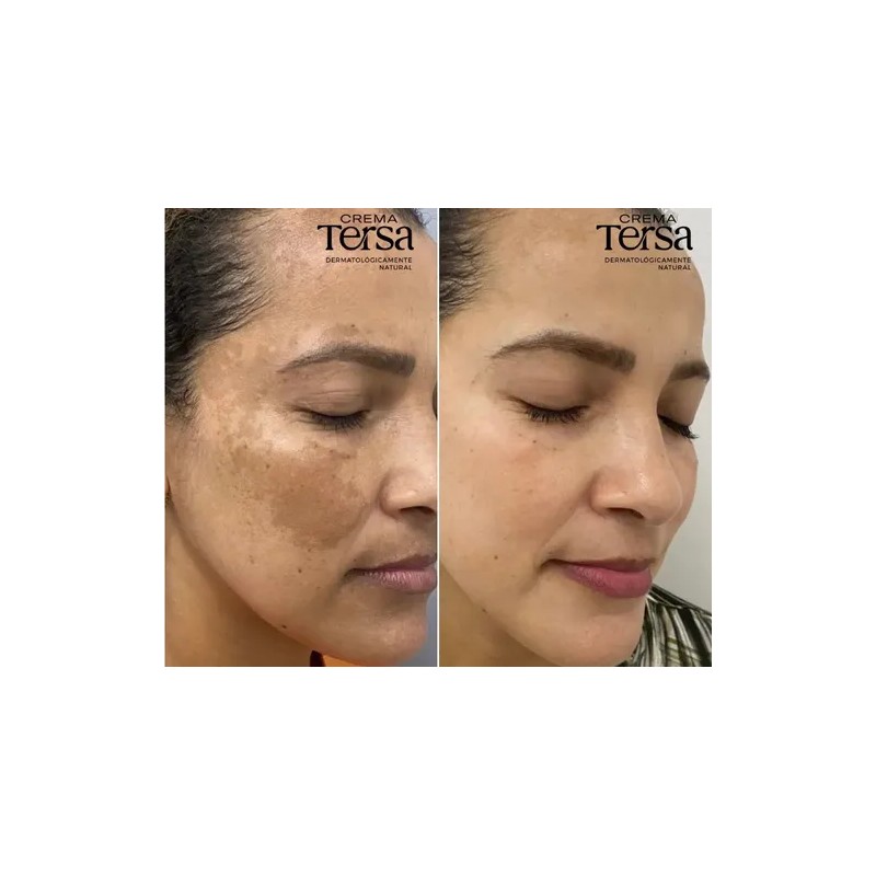 Crema Tersa Despigmentante Quita Manchas Acné Paño De 40g