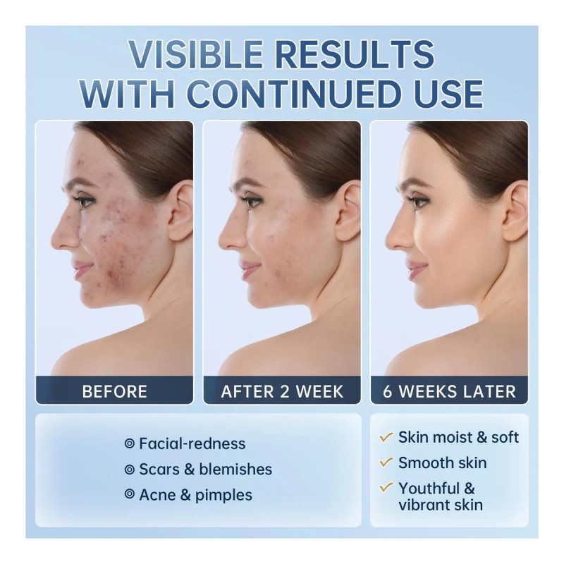 Ácido Azelaico Al 14% De Crema De Acné Para Alivio