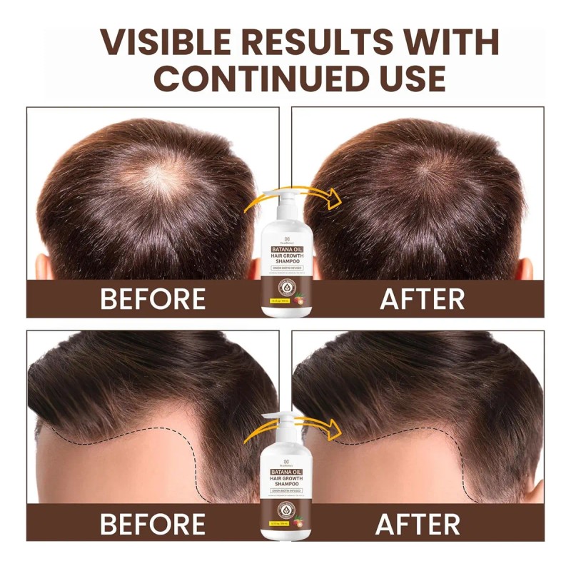 Batana Oil Hair Growth Shampoo: Natural Hair Loss Shampoo...
