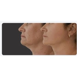 Crema Gel Adelgaza Papada Cuello Escote Reafirma Colageno 40