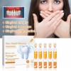 generic 14 Piezas De Gel Dental Para Restauración