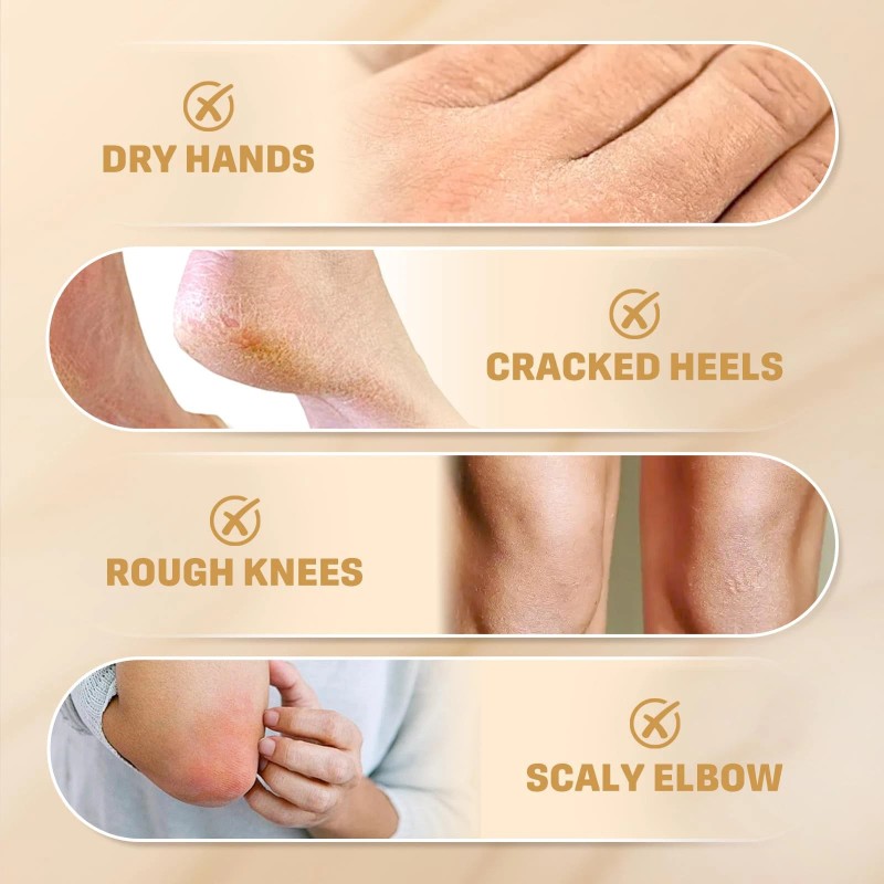 Clyecfra 60% Urea Cream with 2% Salicylic Acid, Urea Cream