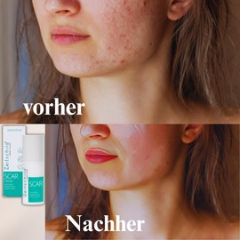 Zeitschild Zeitschild? Narbenpflege Creme C Regenerierende Pflege f1r frische & reife Narben | Mit Madecassoside, Hyaluron & Ectoin | F1r alle Hauttypen | Ohne Parf1m, Silikone & Konservierungsmittel, 30 ml