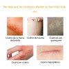 Crema Para Eliminar Cicatrices Quirúrgica Crema Para Estrias