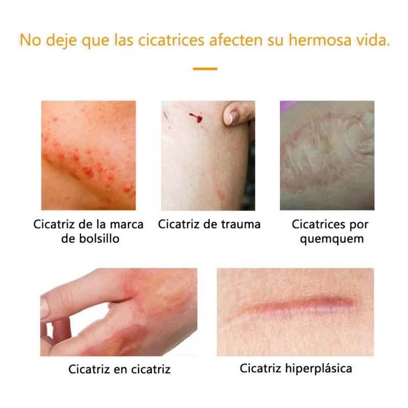 Crema Para Eliminar Cicatrices Quirúrgica Crema Para Estrias