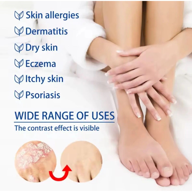 Pomada Psoriasis Natural Antipicazón Hongos Efectiva 20g