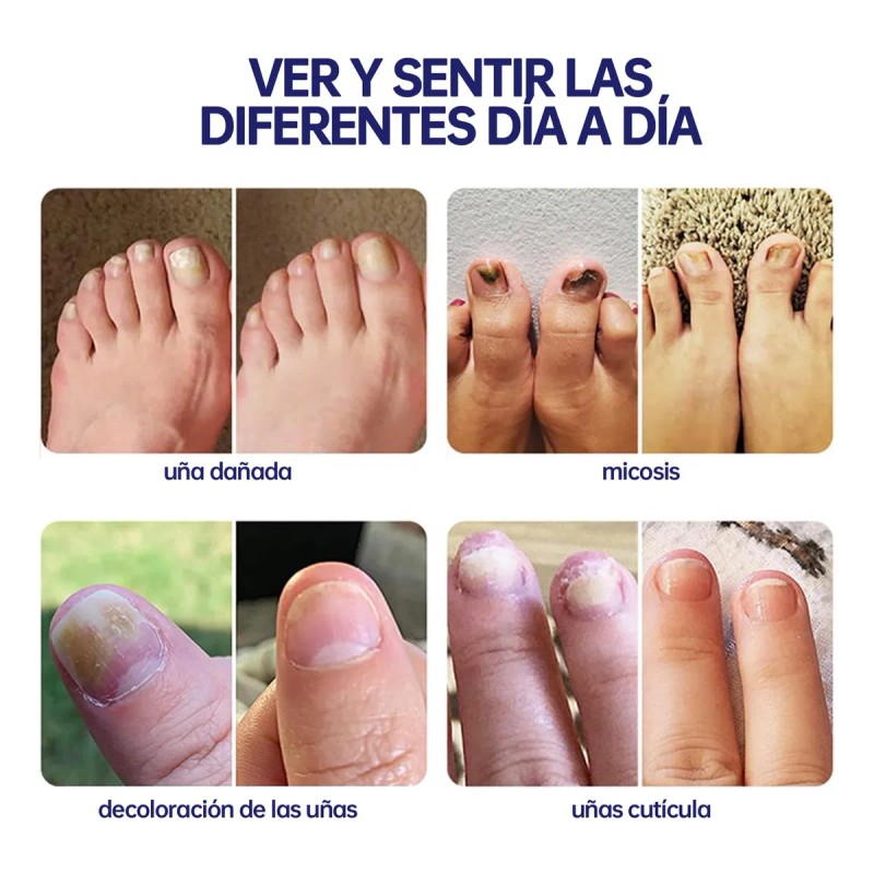 2 Piezas Líquido Reparador De Uñas De Los Pies, Paronychia