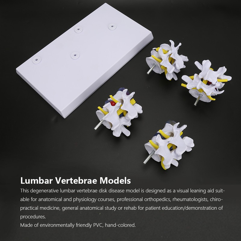 4-stage Medicals Human Lumbar Vertebrae Combination of Normal and Pathological