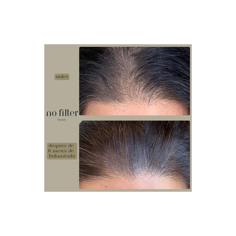 No Filter Beauty Kit de Microinfusión Capilar Hair Growth para