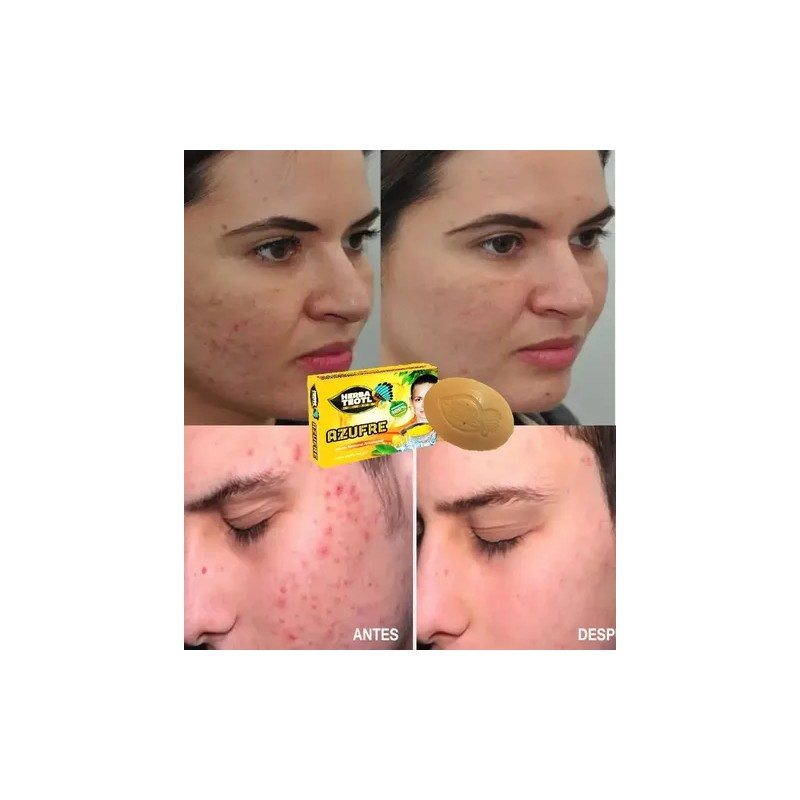 Jabón Artesanal De Azufre 4 Pzs Para Los Barros Y