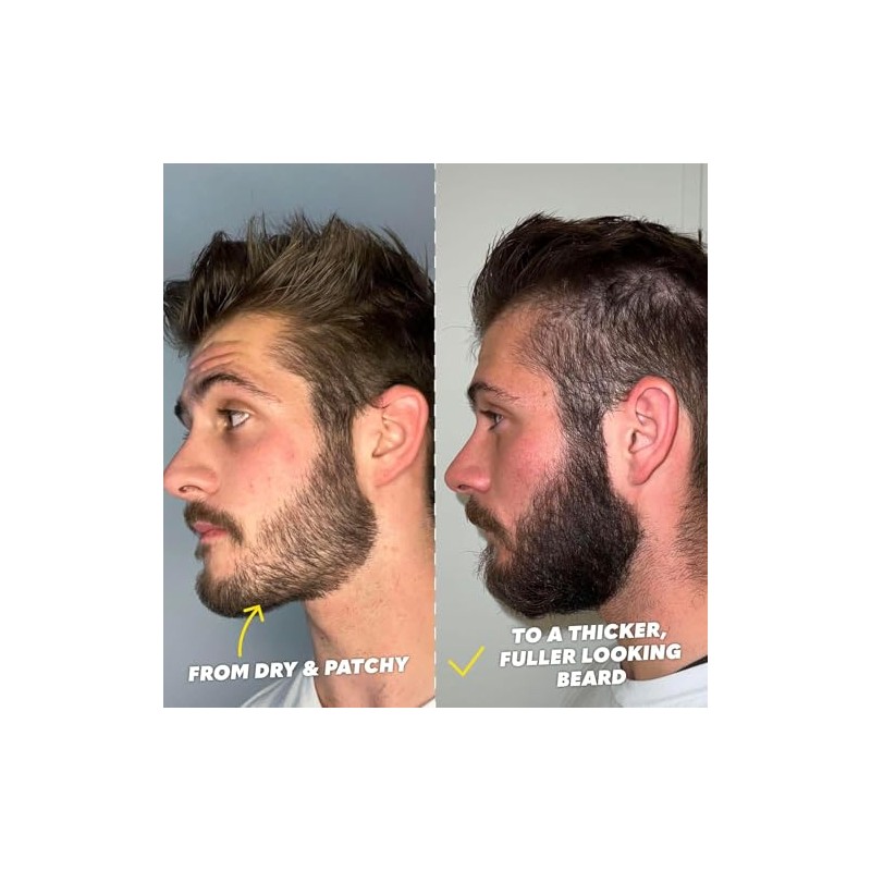 The Beard Club Titanium Beard Growth Kit - Derma Roller,