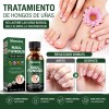 Eelho Líquido Para Hongos En Uñas Cura Hongos Y Onicomicosis