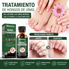Eelho Líquido Para Hongos En Uñas Cura Hongos Y Onicomicosis