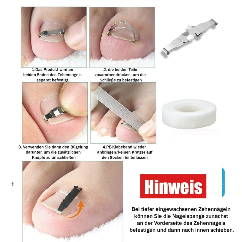 Esshogo 1 Set Ingrown Toenail Tools, Nail Correction Buckle, Patch