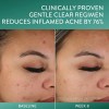 Crema Hidratante Cetaphil Para Acné Pieles Grasas Efecto Ma
