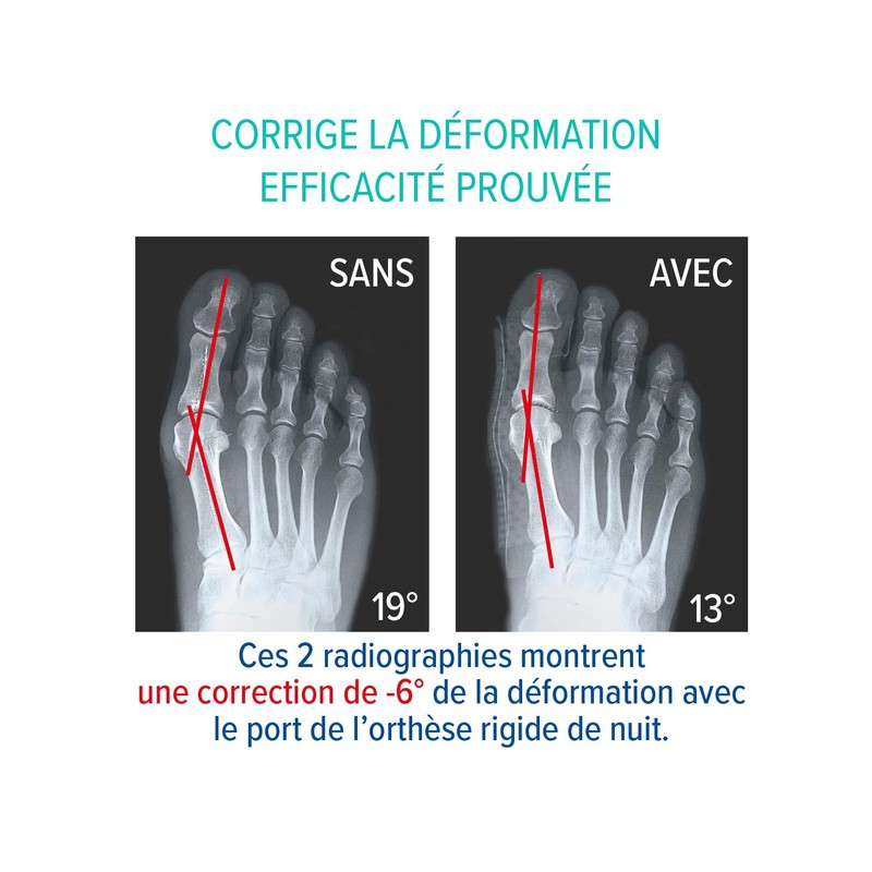 EPITACT - Hallux Valgus "Oignon" - Night Correction Bandage -
