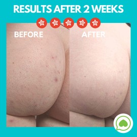 Butt Acne Clearing Lotion (2 pack) for back, buttocks, & thighs - Clears away acne breakouts and reveals new brighter skin