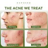 Acne Clearing Tonic Treatment Toner by Exposed Skin Care, Salicylic