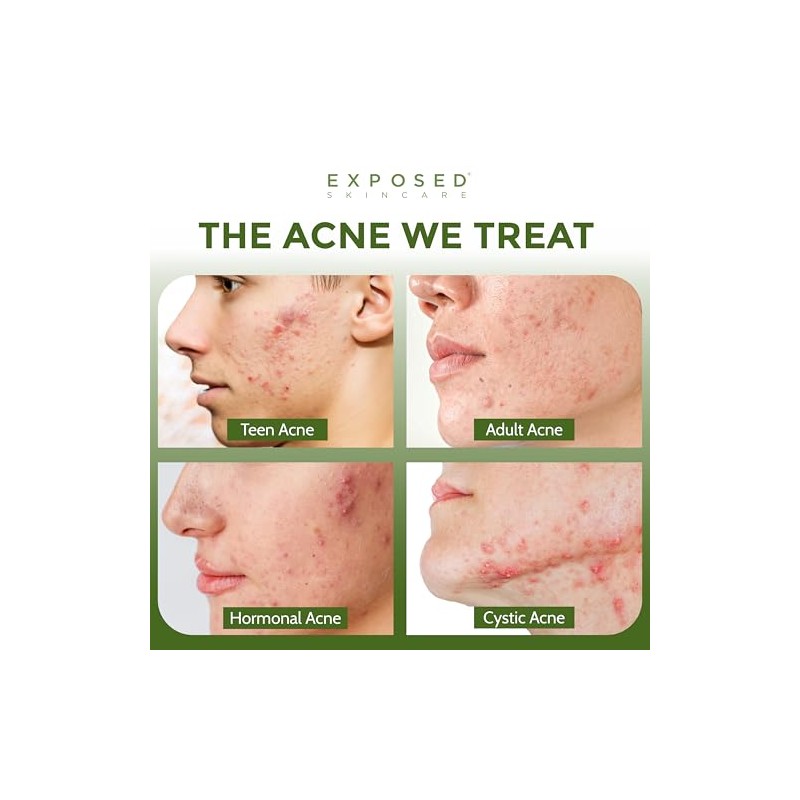 Acne Clearing Tonic Treatment Toner by Exposed Skin Care, Salicylic