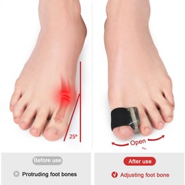 JSHshield Big Toe Separator, Bunion Corrector, Hallux Valgus Splint, Toe Protection, Relief from Bunions, Overlaps, Drifting Toes or Other Discomfort