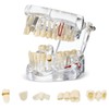 Outus Disease Teeth Model Dental Typodonts Implant Teeth Model with