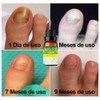 Aceite Esencial De Árbol De Té Antimicotico 100% Natural