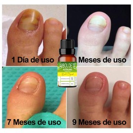 Aceite Esencial De Árbol De Té Antimicotico 100% Natural