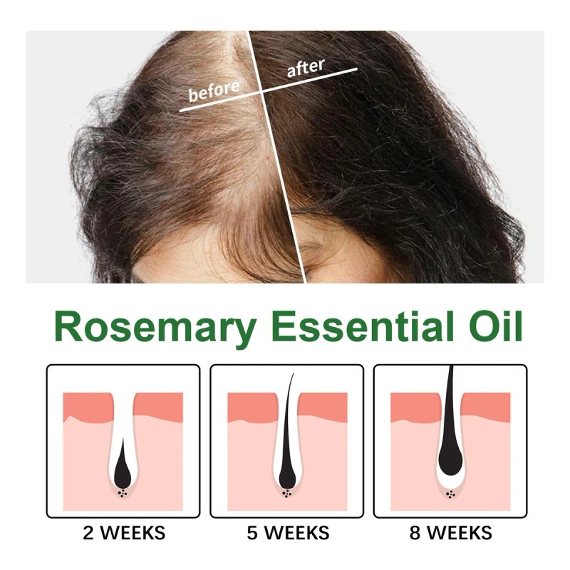 Aceite Esencial De Romero Para El Crecimiento Del Cabello