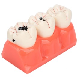 Tankredrug 4 Times Caries Evolution Model Detachable Teeth Disease Teach Anatomy Model for Dentist Teaching Learning