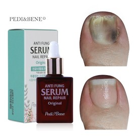 Buzel Viewgel Pedibene Antipung Original 10ml nail art material for problematic nails + 1 top gel / 뷰젤 페디베네 안티펑 오리지널 10ml 네일아트 재료 문제성 손발톱 +탑젤1개