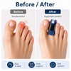 Toe Straightener Splint for Daily Support – Comfortable Hammer Toe