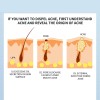 Gel Retinoide Tópico Para El Tratamiento Del Acné