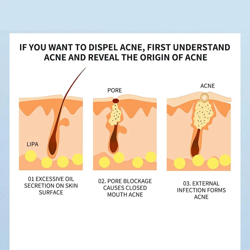 Gel Retinoide Tópico Para El Tratamiento Del Acné