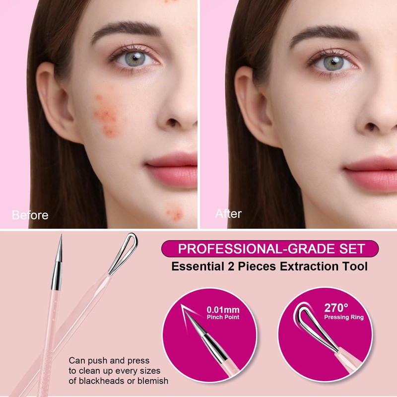 Teenitor Pimple Extractor Acne Treatment Tool Blackhead Comedone Removal 2-in-1