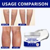 Varicose Veins Treatment for Legs- 2025 Varicose Vein Cream, Spider