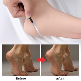 MBAIYO 6 Pack Ingrown Toenail Removal Kit, Professional Pedicure Tools for Ingrown Toenail Callus Shaver Corn Removers for Toes Stainless Steel Nail Knives Kit with Storage Box