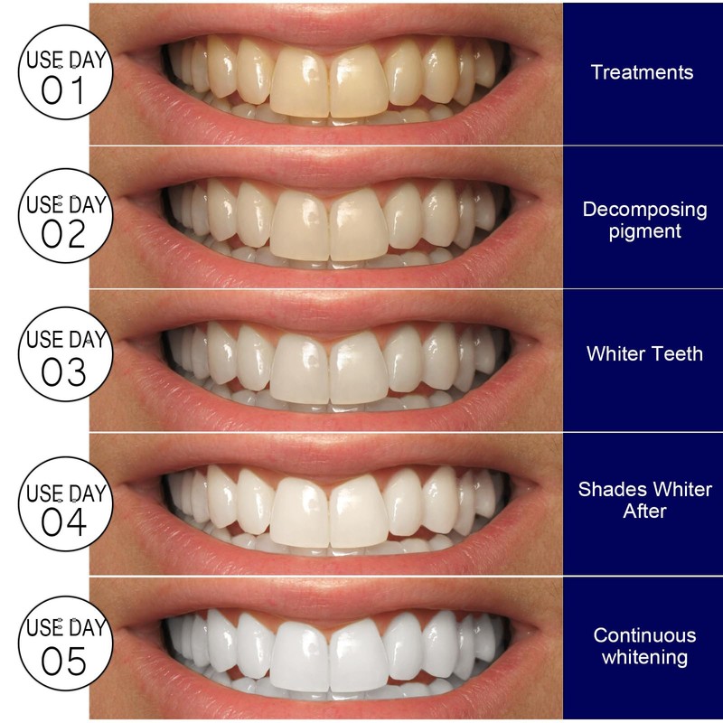 5D Teeth Whitening Strips with 30-Minute Application, Visible Brightening Teeth