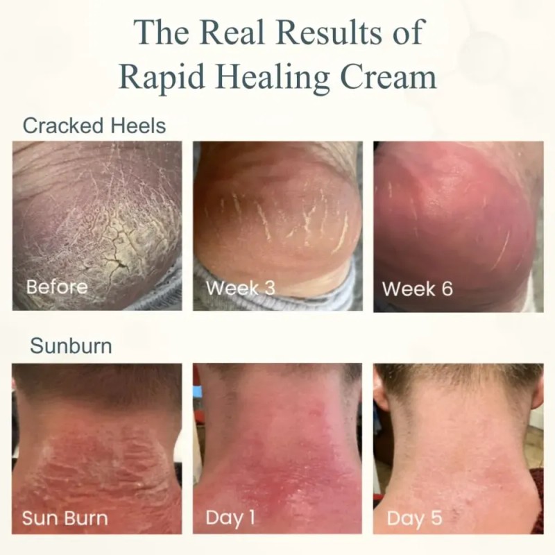 Cream, Growth Factor Skin Repair For Cracked Heels, Hands,