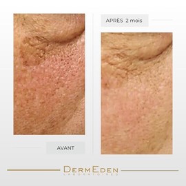 Dermeden - Crema intensa para contorno de ojos antienvejecimiento, 15 ml
