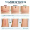 Parches Silicona Cicatrices Láminas Reutilizables Cesárea Acné